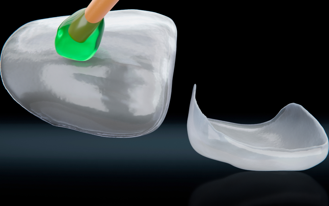 applying glue to veneer onlay