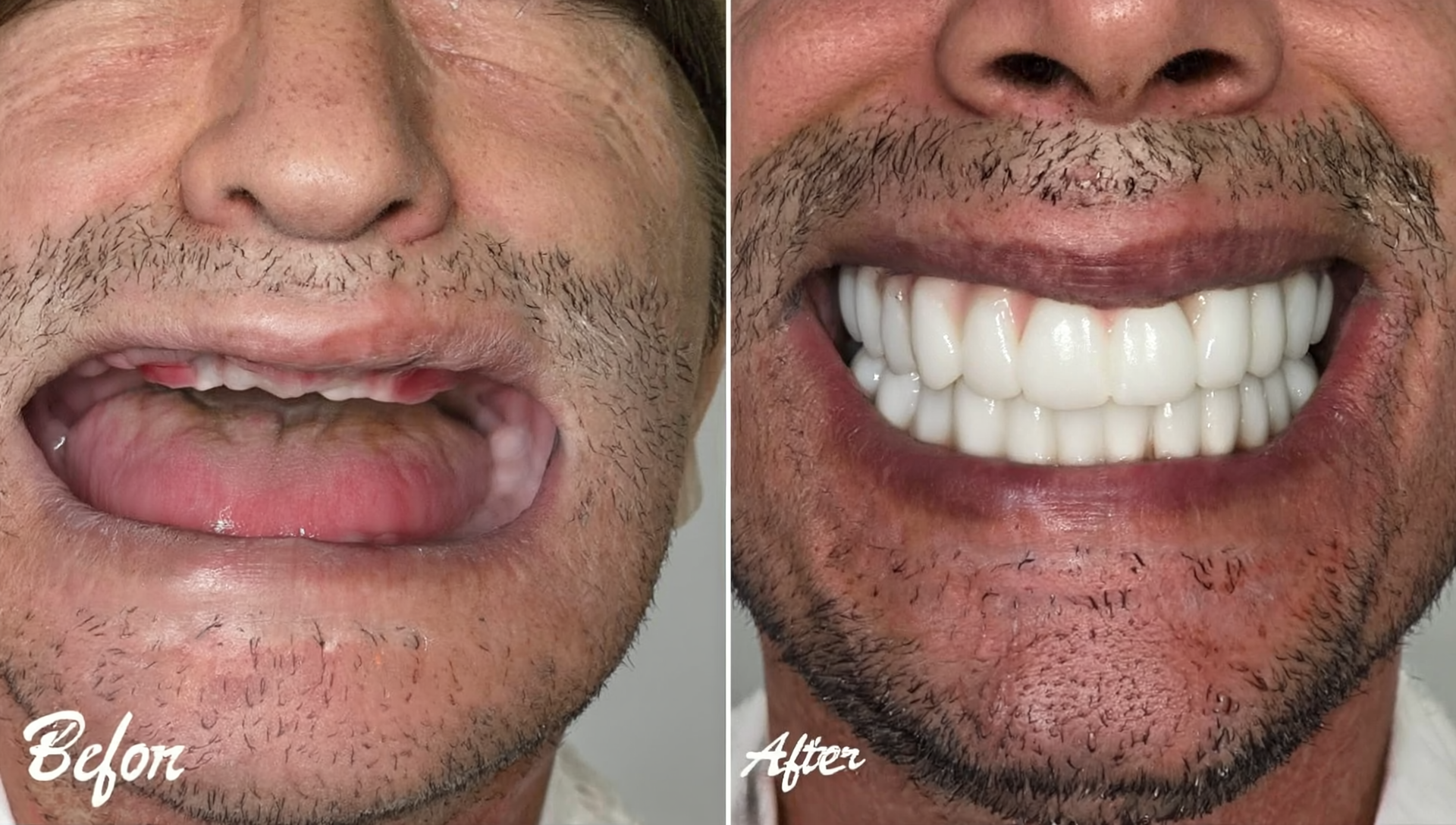 Zoom teeth whitening near you